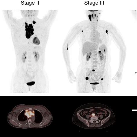 Pre Treatment 18 F Fdg Petct For Staging Of Lymphoma Based On The Ann