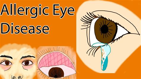 Allergic Eye Disease Allergic Conjunctivitis And Vernal