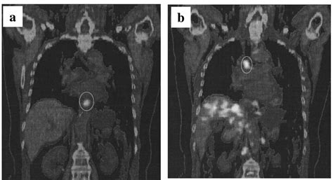 A Case Of Esophageal Cancer With Multiple Lymph Node Metastases Which