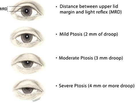 Check spelling or type a new query. Ptosis Singapore - Droopy Eyelid Treatment - The Look Book