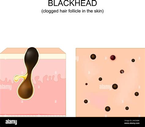 Aggregate Clogged Hair Follicle Best In Eteachers