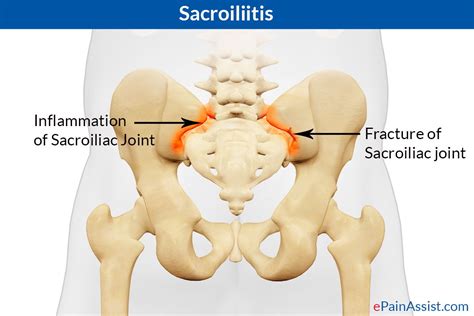 A Helpful Guide To Sacroiliac Joint Fusion For Pain And Dysfunction