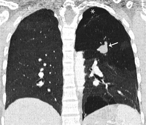 Bronchial Atresia Radiographics