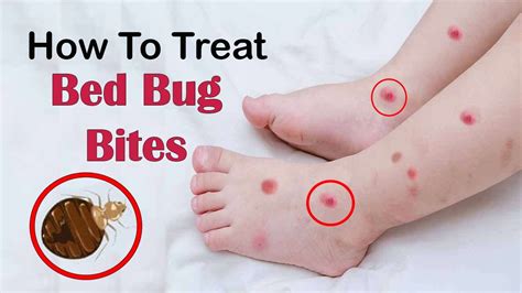 How To Treat Bed Bug Bites Fast At Home Home Remedies For Bed Bugs