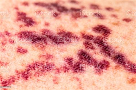 Purpura Vasculitis Or Broken Blood Vessels On Human Skin Stock Photo