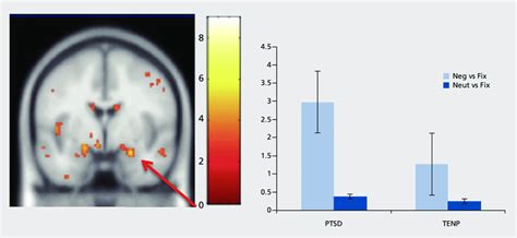 Activation In The Right Amygdala Is Enhanced In Post Traumatic Stress