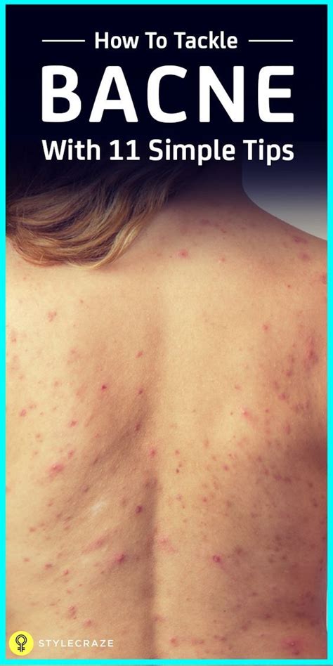 What are the different types of acne on the shoulders? How To Get Rid Of Back Acne Naturally: 17 Home Remedies in ...