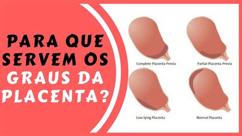 O Que é Placenta Grau 1