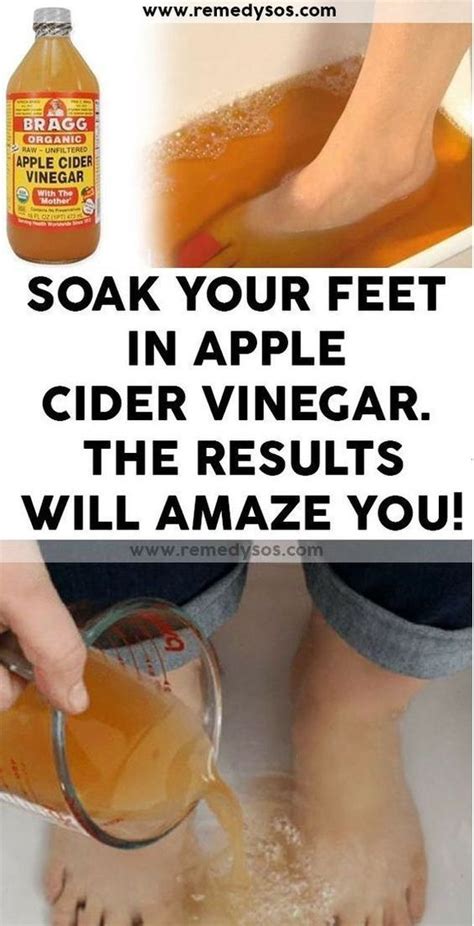 After Soaking Your Feet In Apple Cider Vinegar Apple Cider Vinegar