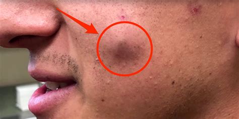 Best Cyst Popping Videos Of 2018 Business Insider