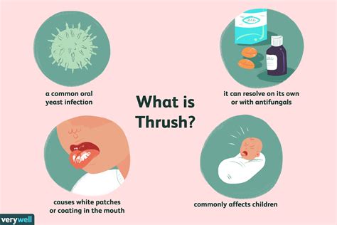 Thrush Oral Candidiasis Overview And More