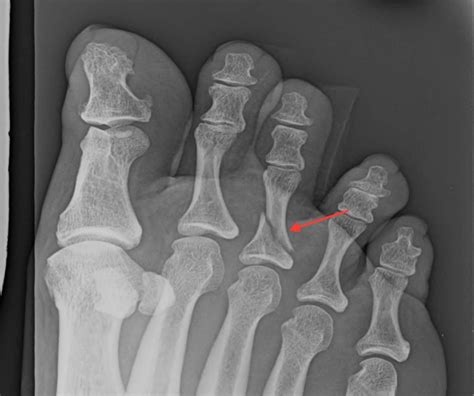 Great Toe Proximal Phalanx Fracture