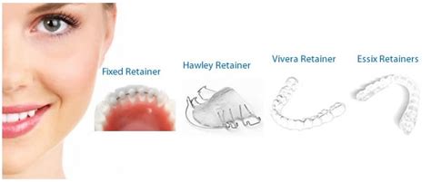 A wide variety of clear retainers options are available to you, such as quality certification, shelf life, and warranty. San Diego Orthodontics and Retainers - Dentist in San Diego