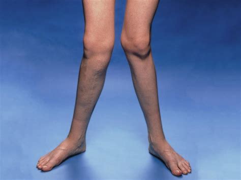 Knock Knees Ages To Babycenter