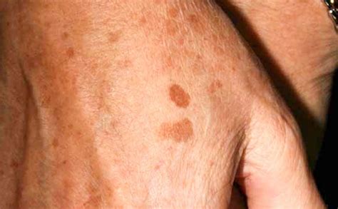 Freckles Causes Identification And Risks