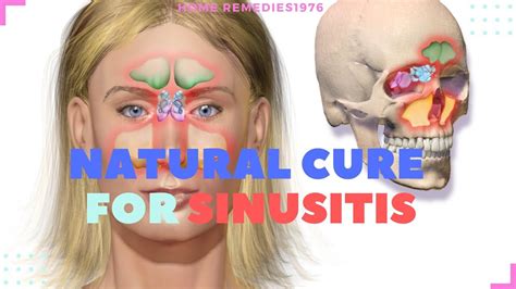 6 natural cures for sinusitis youtube