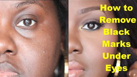 How To Remove Black Marks Under Eyes Get Rid Of Dark Circles Youtube