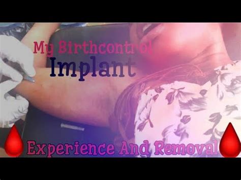 My Nexplanon Implant Experience And Removal YouTube