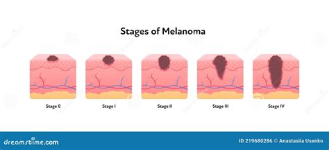 Melanoma Cancer Anatomical Infographic Poster Vector Flat Medical