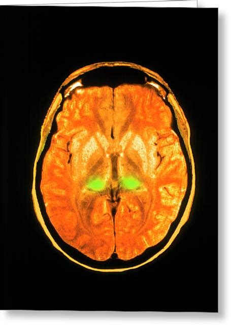 Coloured Mri Scan Of Human Brain Diseased With Cjd Photograph By Simon