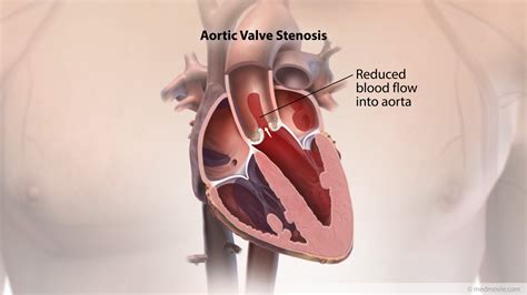 Aortic Stenosis Medmovie