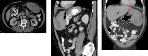Axial Sagittal And Coronal Ct Images Of The Abdomen Demonstrate A 13 ×