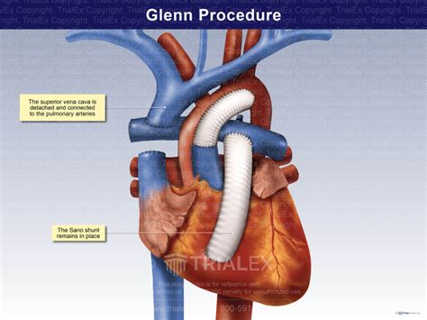 Glenn Procedure Trial Exhibits Inc