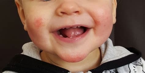 Jetzt heißt es endlich wieder: Ist das Neurodermitis? ?? - Kleinkind-Gruppe - BabyCenter
