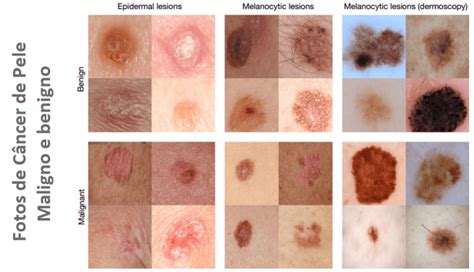 Câncer De Pele Grupos E Fatores De Risco Principais Sintomas
