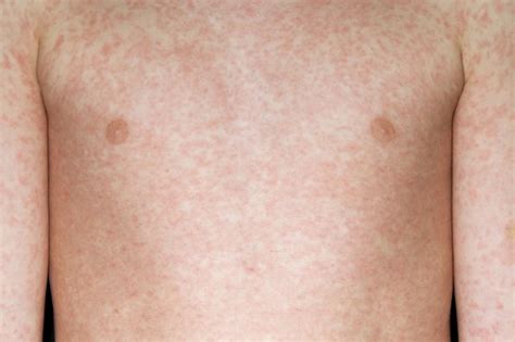 Measles Symptoms Nhsuk