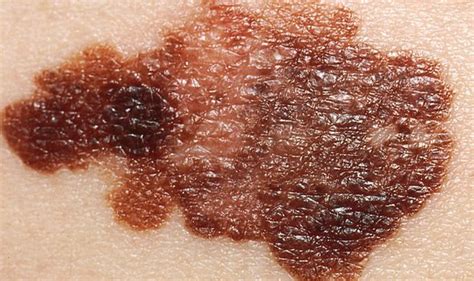 Skin Cancer Symptoms Five Signs Of The Deadly Disease You Need To Kno