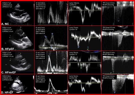 Spectrum Of Progressive Echocardiographic Abnormalities In Patients