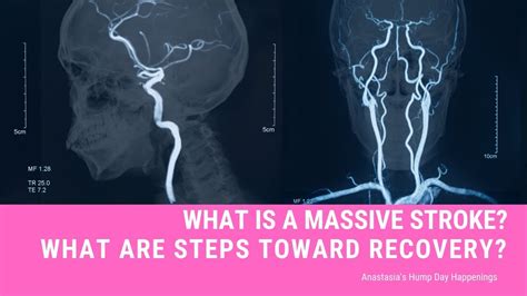 Massive Stroke What To Expect With Recovery And Rehabilitation Options