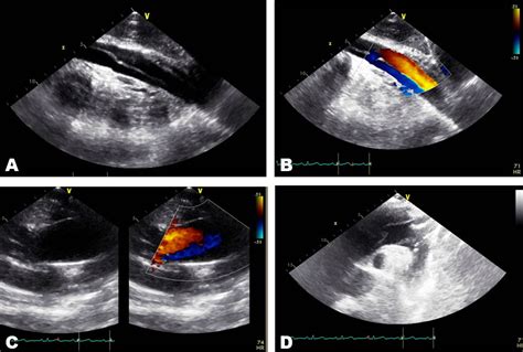 A Rare Presentation Of Aortic Dissection International Journal Of