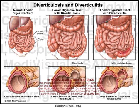 Diverticulosis And Diverticulitis Medical Illustration Medivisuals