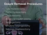 What Are The Side Effects Of The Essure Pictures