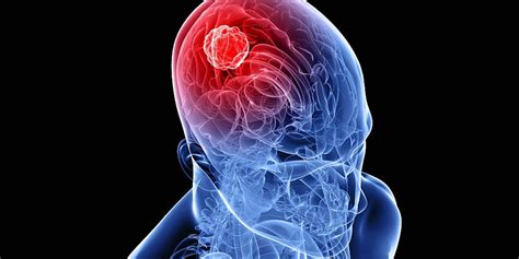 However, neuroblastoma is an exception; Research: Device Claims To Suppress Brain-Cancer Cell Growth