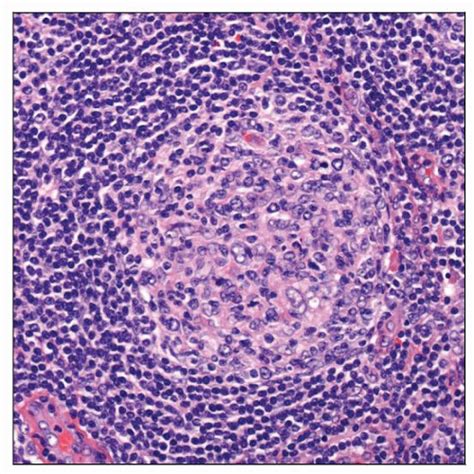 Reactive Follicular Hyperplasia Basicmedical Key