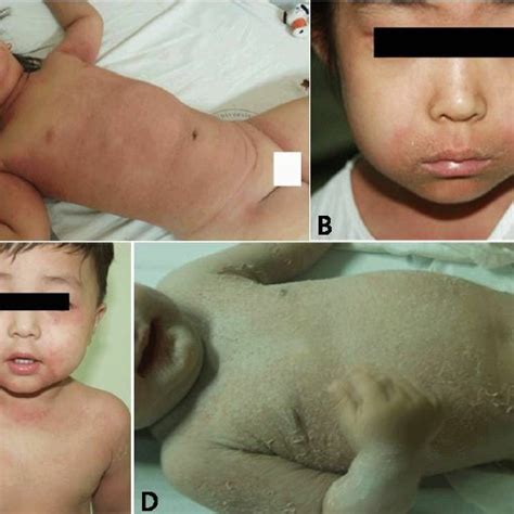 Pdf Regional Outbreak Of Staphylococcal Scalded Skin