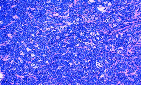 Burkitt Lymphoma Diffuse Infiltration In A Starry Sky Pattern With
