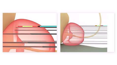 Prostate Brachytherapy Hdr Ldr Prostate Brachytherapy