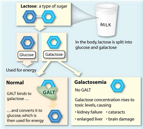 Classic Galactosemia And The Causative Gene Galt Home