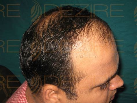 Hair Restoration Physician Done At Dezire Clinic Pune Hair Transplant