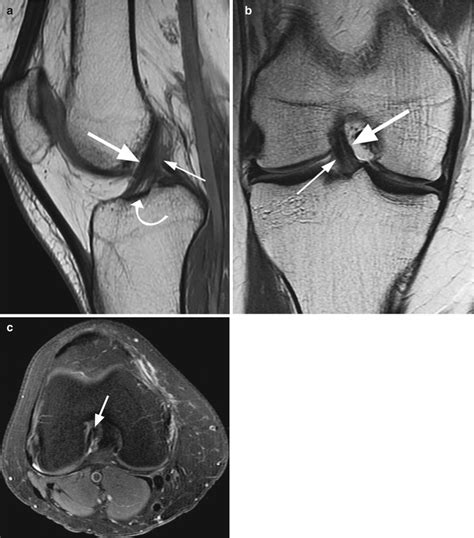 A clinical and mri study.clinical. Anterior Cruciate Ligament (ACL) | Radiology Key