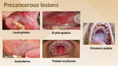 Epidemiology Of Oral Cancer