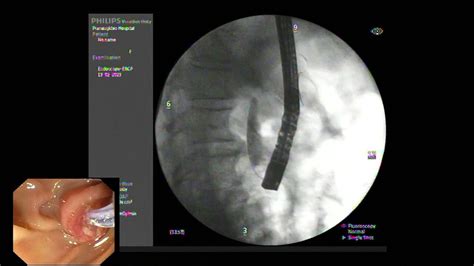 Ercp Est And Epbd For Cbd Stones Removal Small Est Bleeding