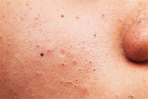 Dr Pimple Poppers Advice On Getting Rid Of Blackheads The Healthy