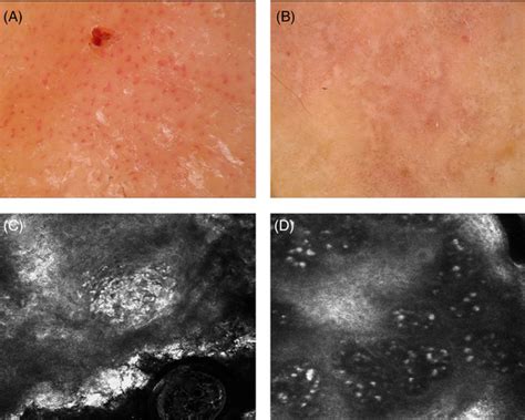 Representative Dermoscopic And Rcm Features Of Inflammatory Skin