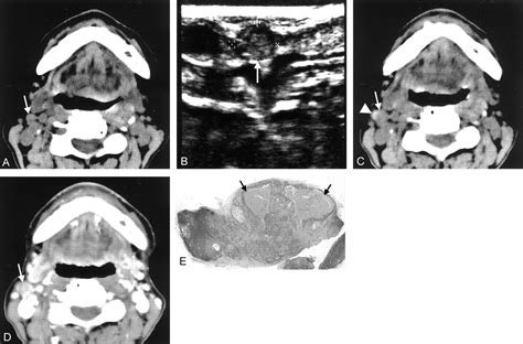 Non Contrast Enhanced Ct Findings Of High Attenuation Within Metastatic