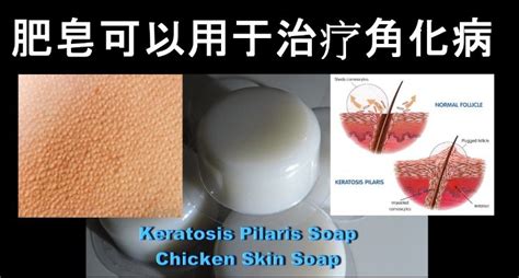 Keratosis Pilaris Treatment Soap With Coconut Oil